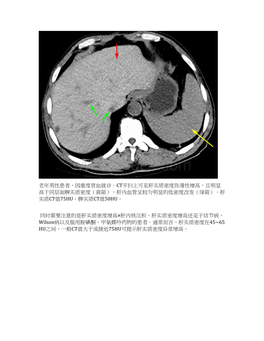 肝脏弥漫性病变的影像学特点Word下载.docx_第3页