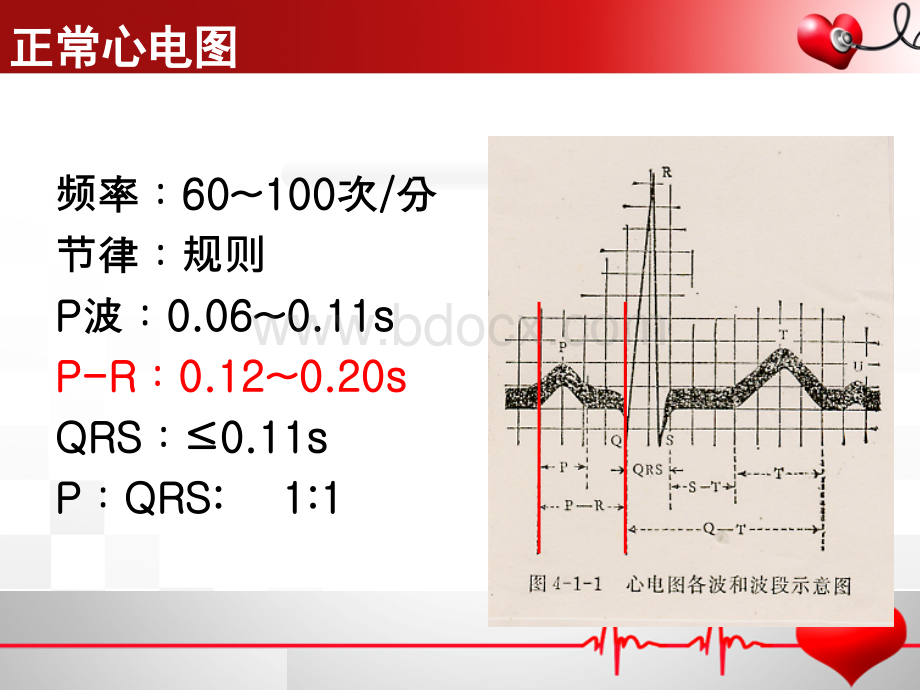 房室传导阻滞.ppt_第3页