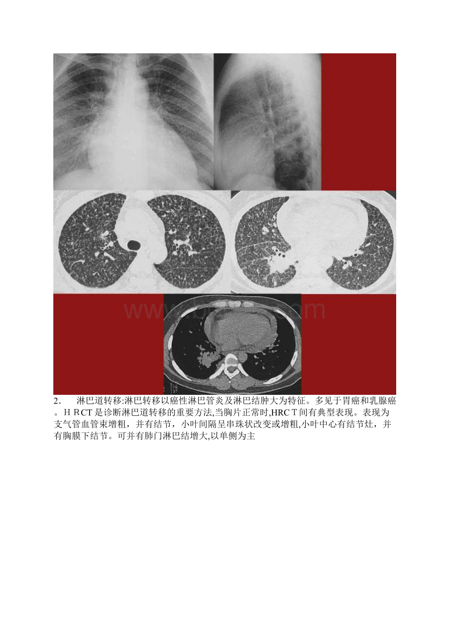 肺部转移瘤的影像诊断.docx_第3页