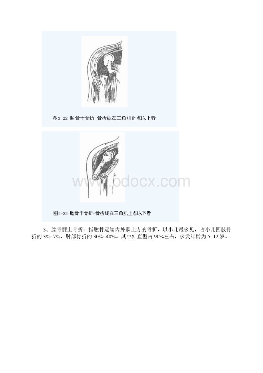 肱骨骨折病人的护理查房.docx_第3页