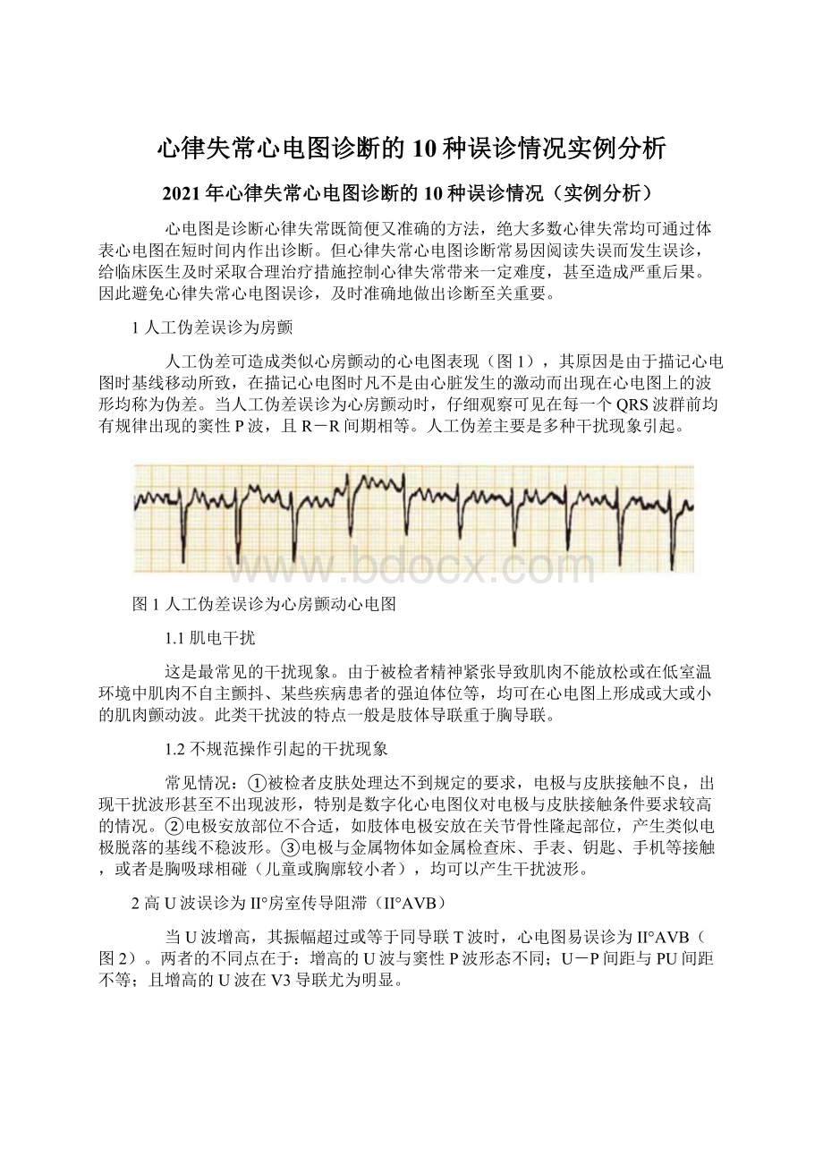 心律失常心电图诊断的10种误诊情况实例分析.docx_第1页