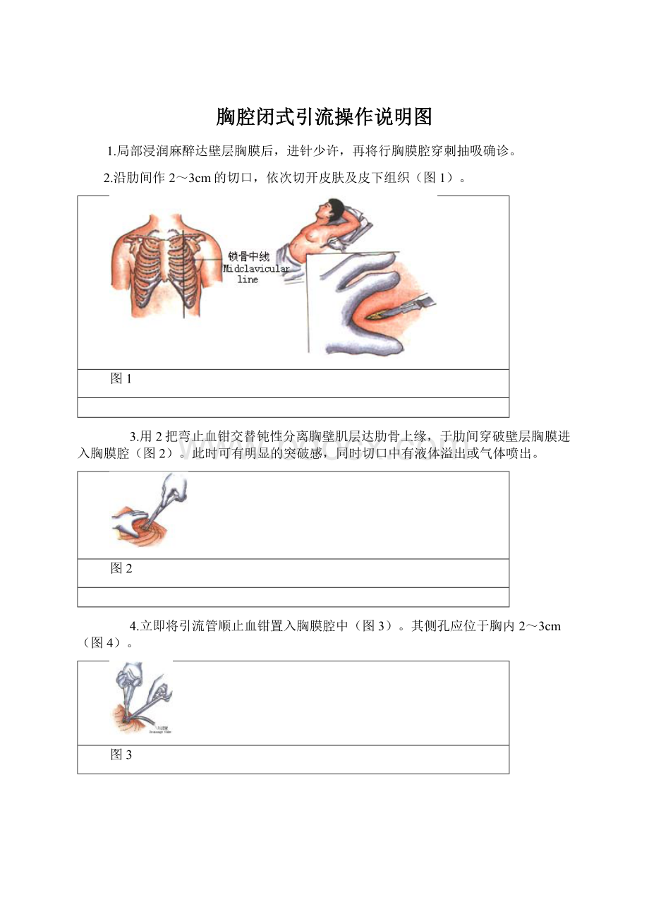 胸腔闭式引流操作说明图Word文件下载.docx