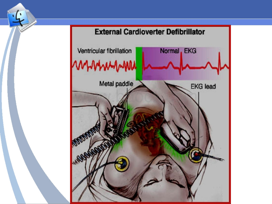 电除颤IPPT推荐.ppt_第2页