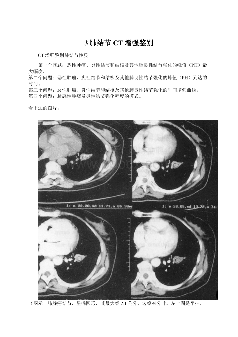 3肺结节CT增强鉴别Word格式文档下载.docx