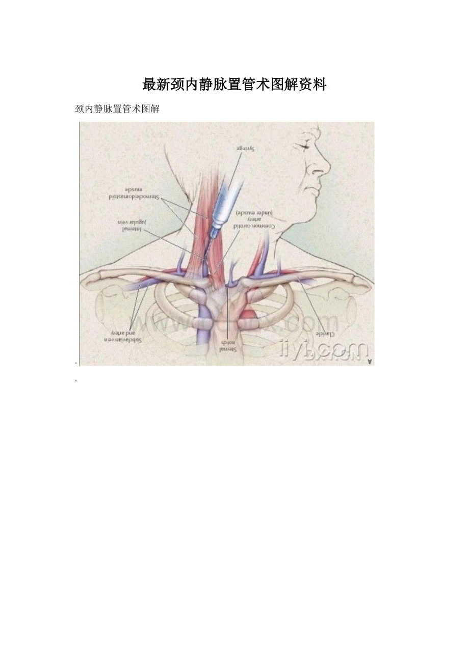 最新颈内静脉置管术图解资料.docx