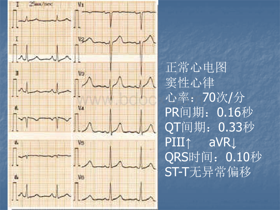 心内科常用心电图图谱读图.pptx_第2页