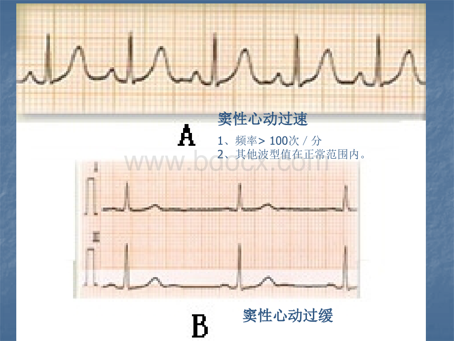 心内科常用心电图图谱读图.pptx_第3页
