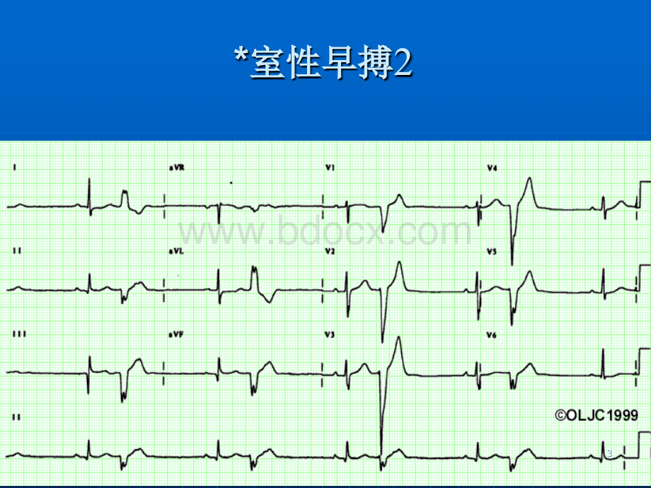 心电图识记.ppt_第3页