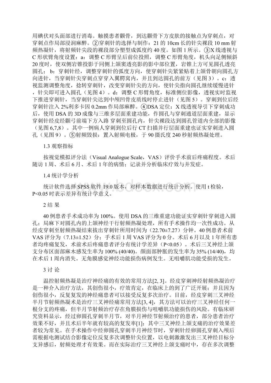 DSA导引弯针技术穿刺圆孔射频治疗上颌神经痛的临床研究.docx_第3页