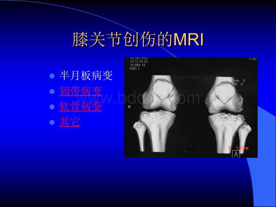 MRI膝关节.ppt_第2页