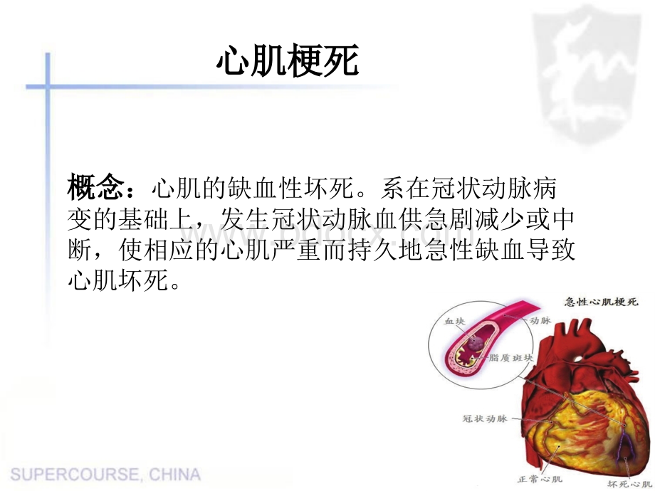 心肌梗死教学查房.ppt_第3页