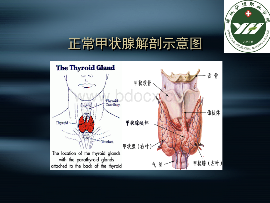 v甲状腺功能亢进症.ppt_第3页