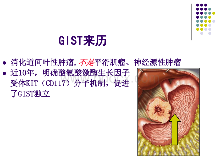 胃肠间质瘤(GIST).ppt_第3页