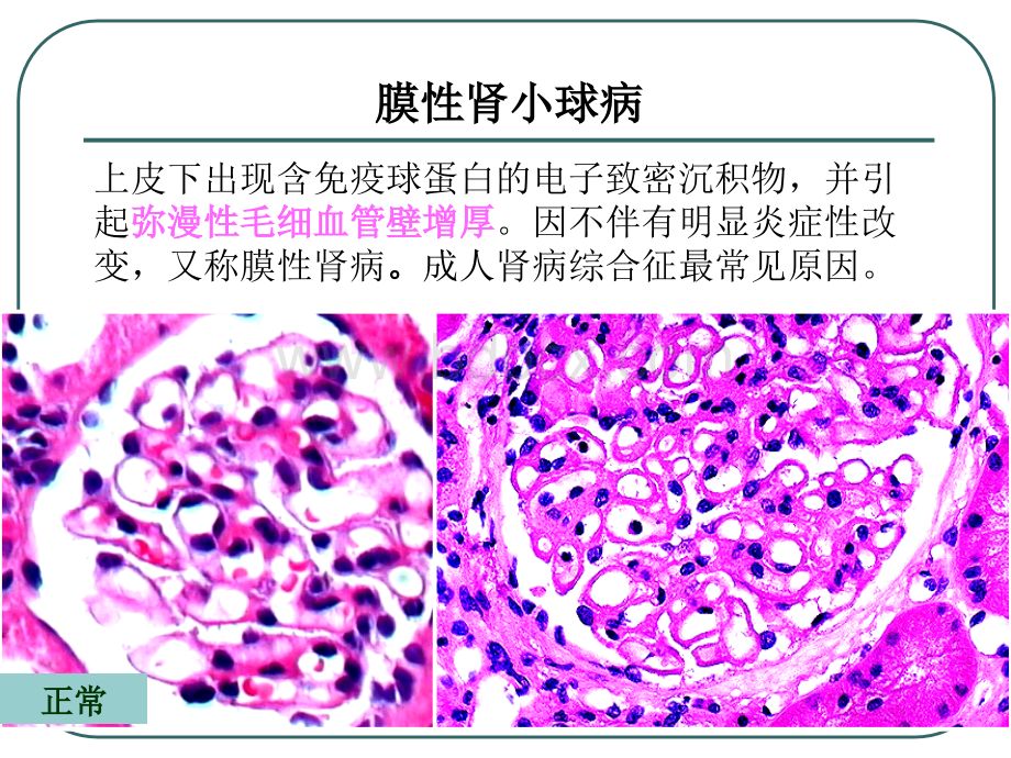 病理学泌尿-2.ppt_第3页