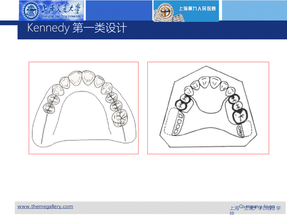 可摘局部义齿的分类设计讲义课件.pptx_第3页