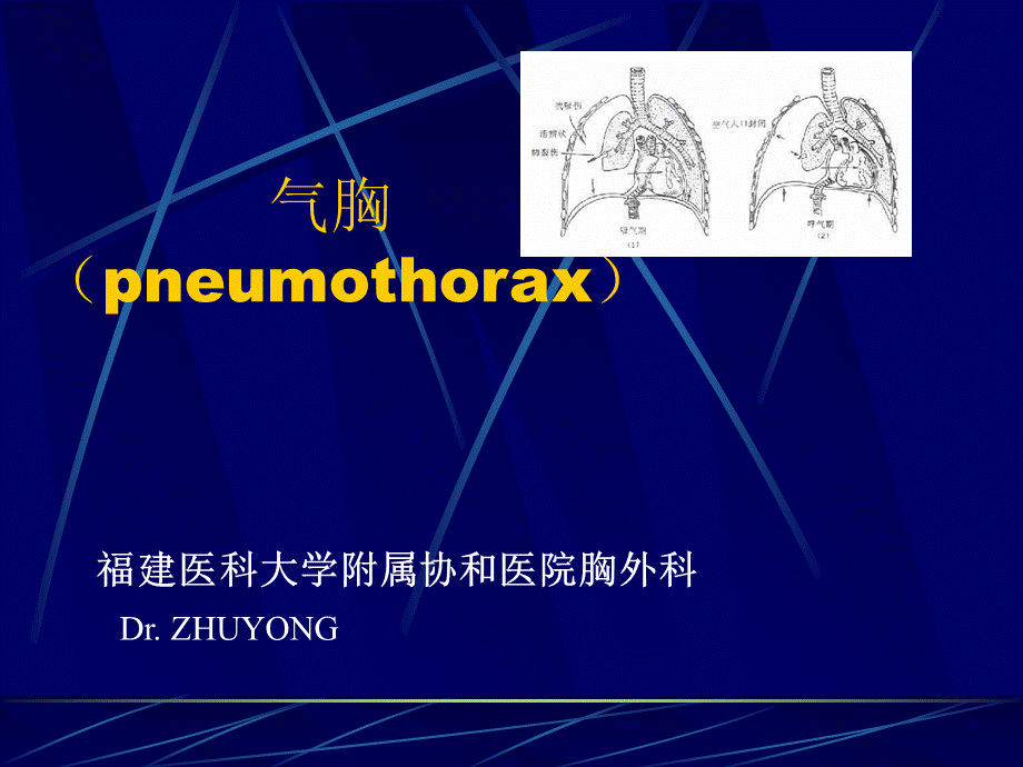 气胸幻灯11教学文稿PPT资料.ppt_第1页