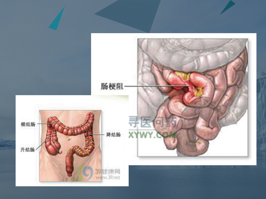 肠梗阻疑难病例讨论.ppt_第2页