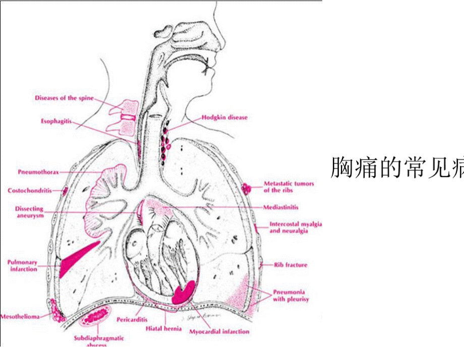 急诊胸痛诊断思路流程及常见胸痛危急重症诊治进展.pptx_第3页