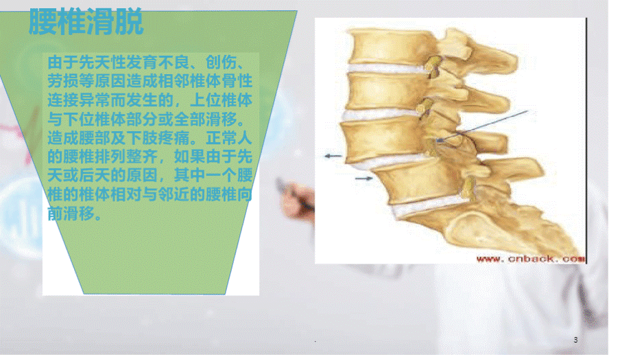 腰椎滑脱症围手术期护理.pptx_第3页