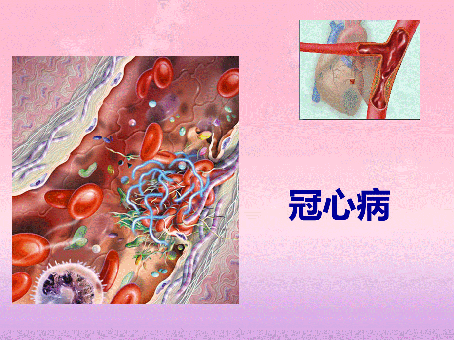 冠心病心绞痛.ppt_第2页