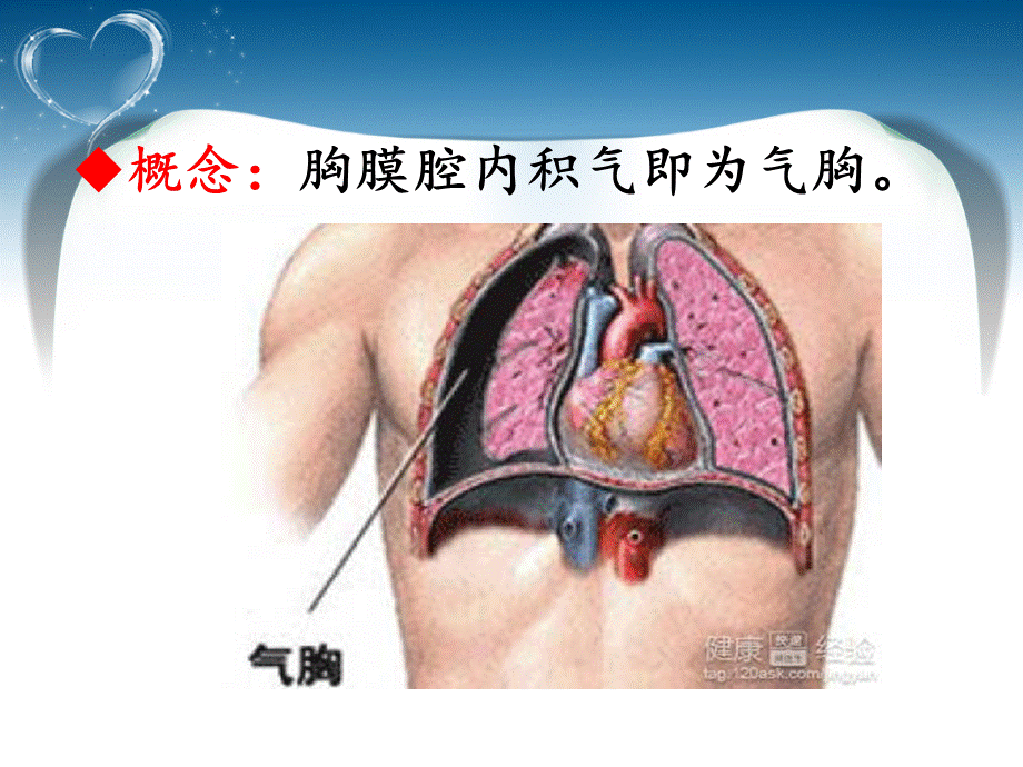 气胸护理讲课.ppt_第3页