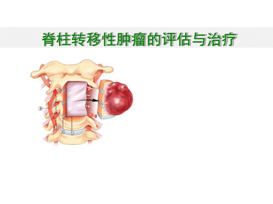 转移性脊柱肿瘤评估与治疗.pptx_第1页