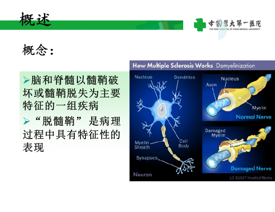 (完整版)中枢神经系统脱髓鞘疾病1PPT格式课件下载.pptx_第2页