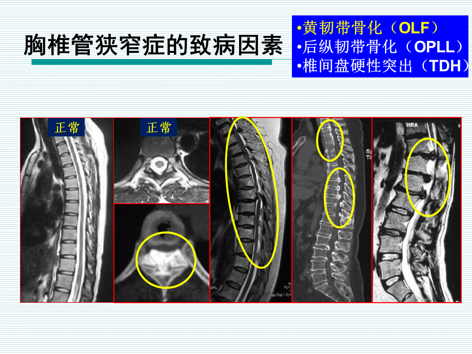 医学学习胸椎管狭窄症-北医三院经验PPT文件格式下载.pptx_第3页