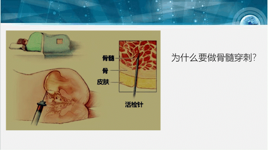 骨髓穿刺术PPT文档格式.pptx_第3页