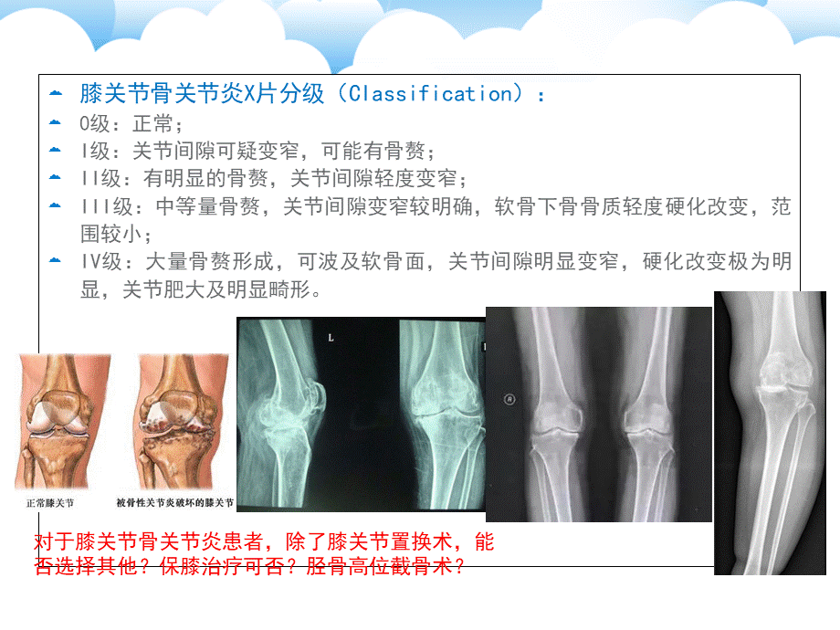 保膝治疗之-——胫骨高位截骨术PPT文件格式下载.ppt_第2页