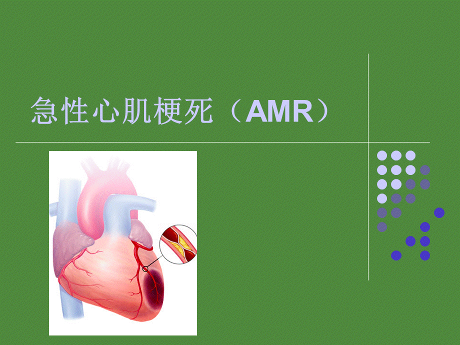 急性心肌梗死护理_查房PPT资料.ppt_第1页