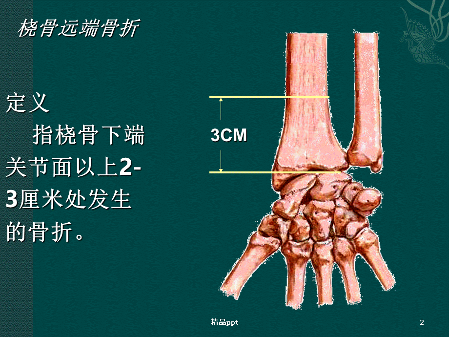 桡骨远端骨折 (2).ppt_第2页