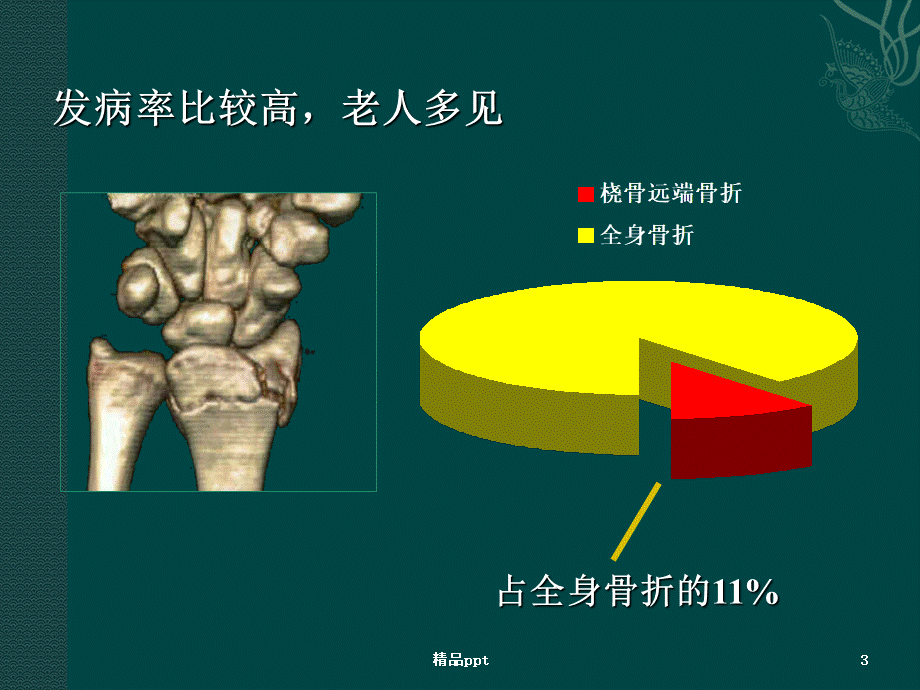 桡骨远端骨折 (2)PPT文档格式.ppt_第3页