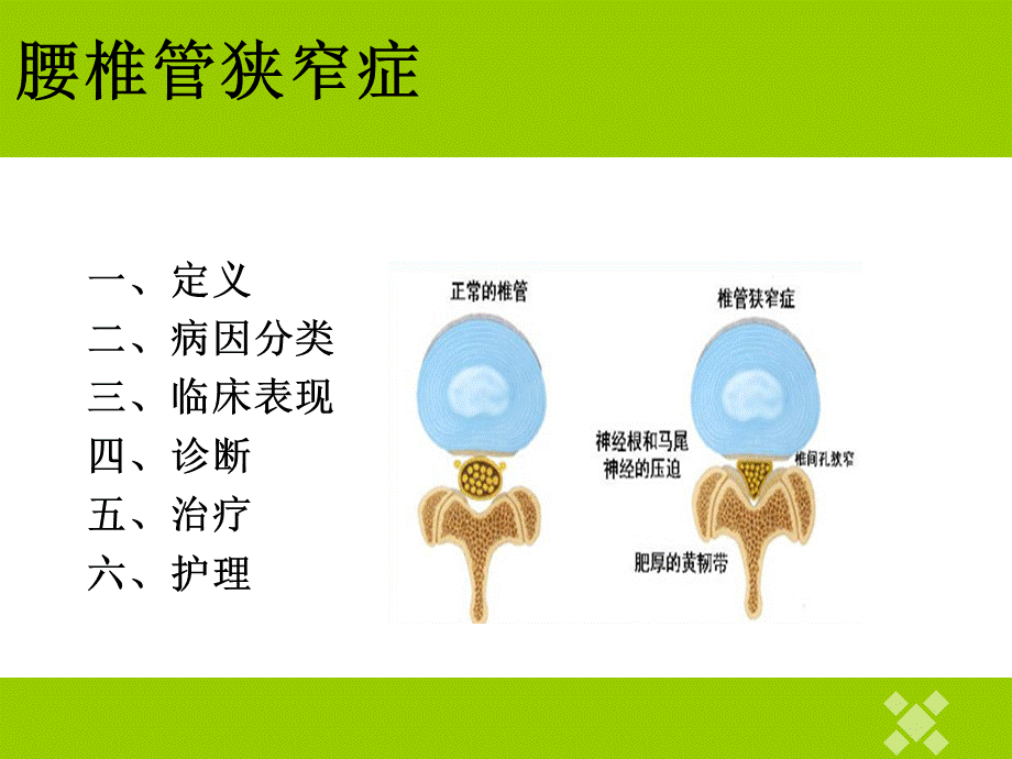 腰椎管狭窄症护理查房PPT课件下载推荐.pptx_第3页