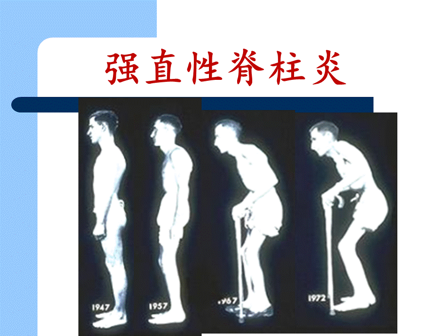 强直性脊柱炎影像诊断PPT格式课件下载.ppt_第1页