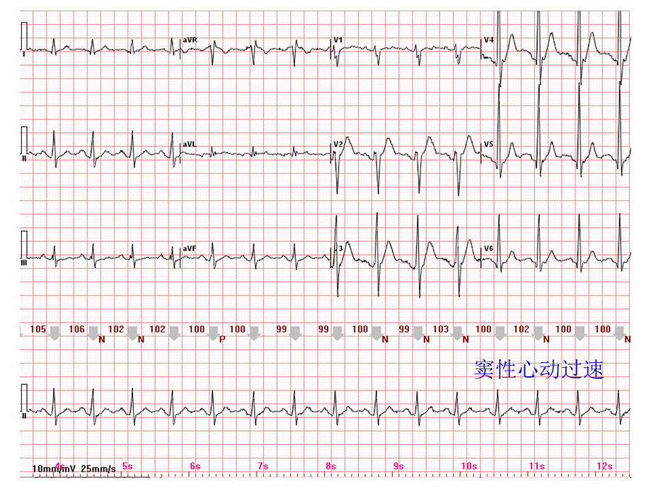 心电图常见正常和异常心电图图谱PPT资料.ppt_第2页