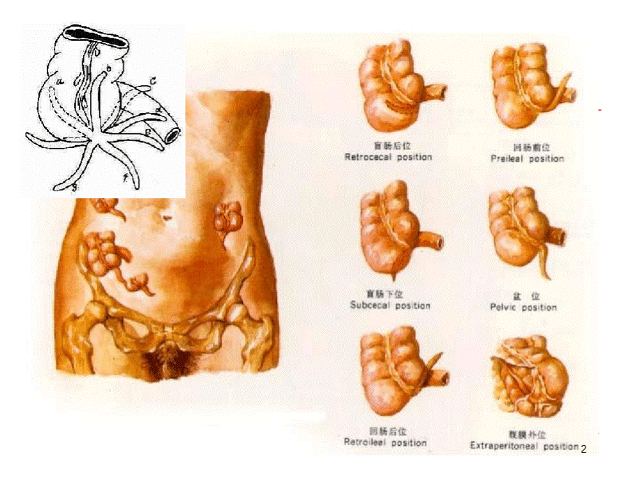 阑尾PPT课件.pptx_第2页