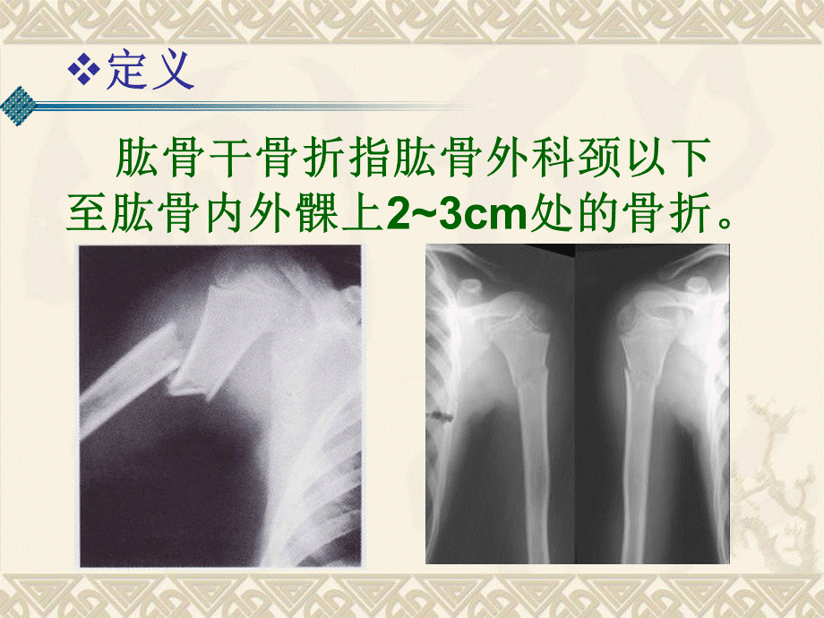 肱骨干骨折-(课件)..ppt_第2页