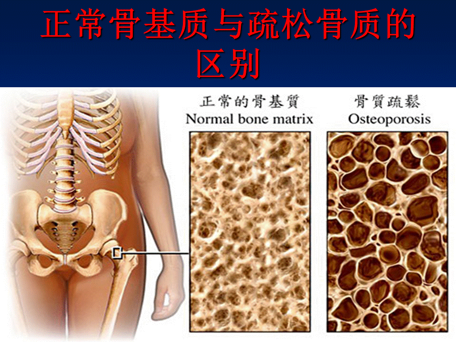 骨质疏松的预防和护理PPT推荐.ppt_第2页