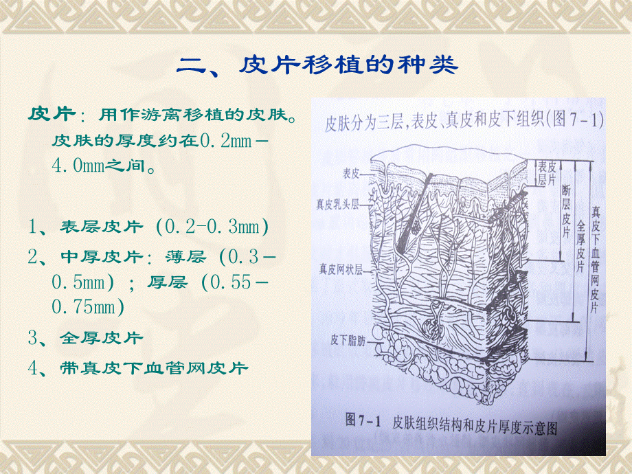 皮片移植.ppt_第3页