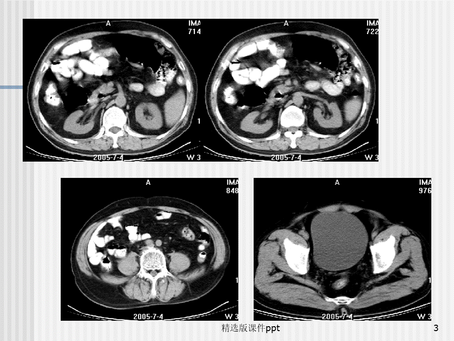 泌尿系统CT检查.ppt_第3页