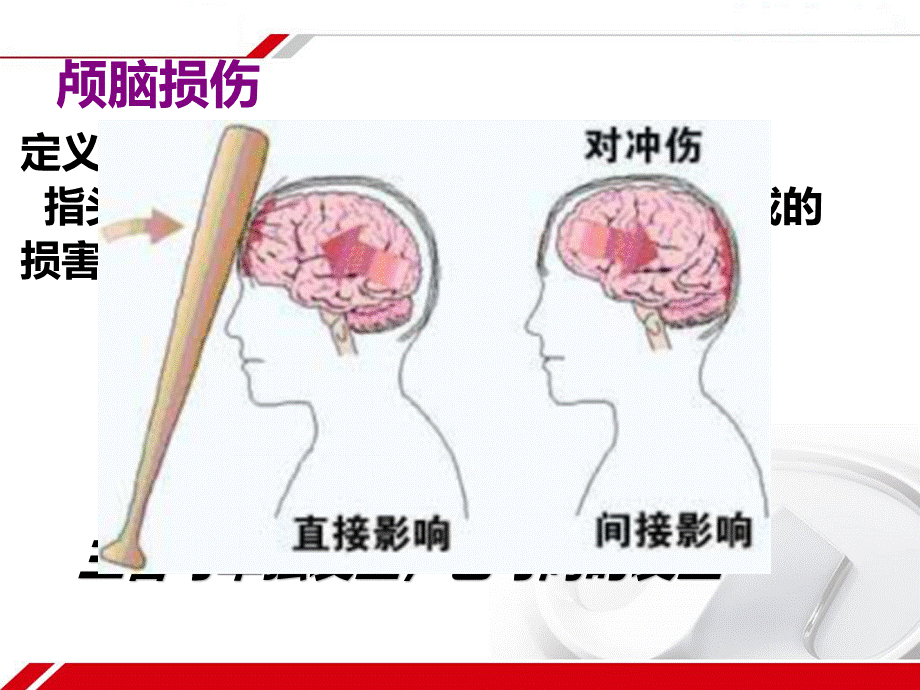 颅脑损伤病人的护理.ppt_第2页