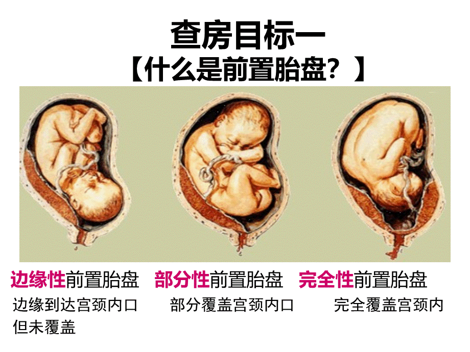 前置胎盘教学查房.ppt_第3页