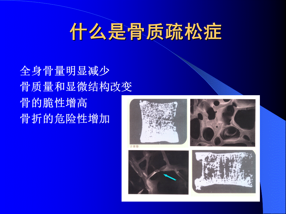 骨质疏松症 (1).ppt_第2页