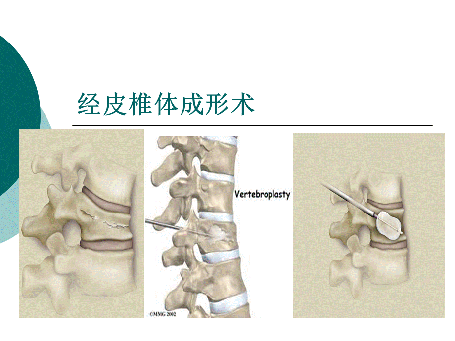 经皮椎体成形术PPT推荐.ppt_第1页