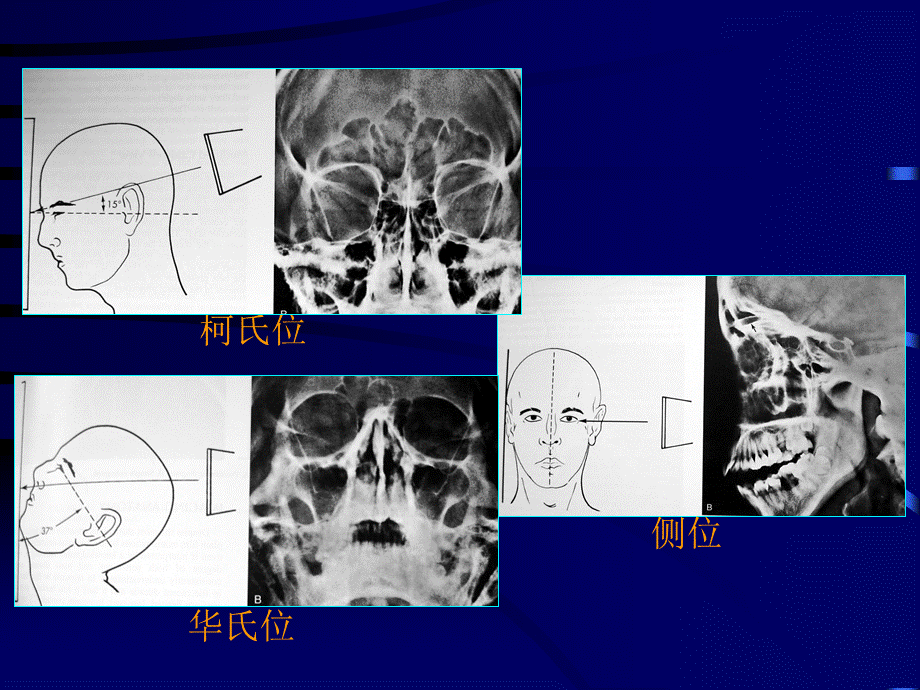 鼻、鼻窦影像学表现 (1)PPT资料.ppt_第3页