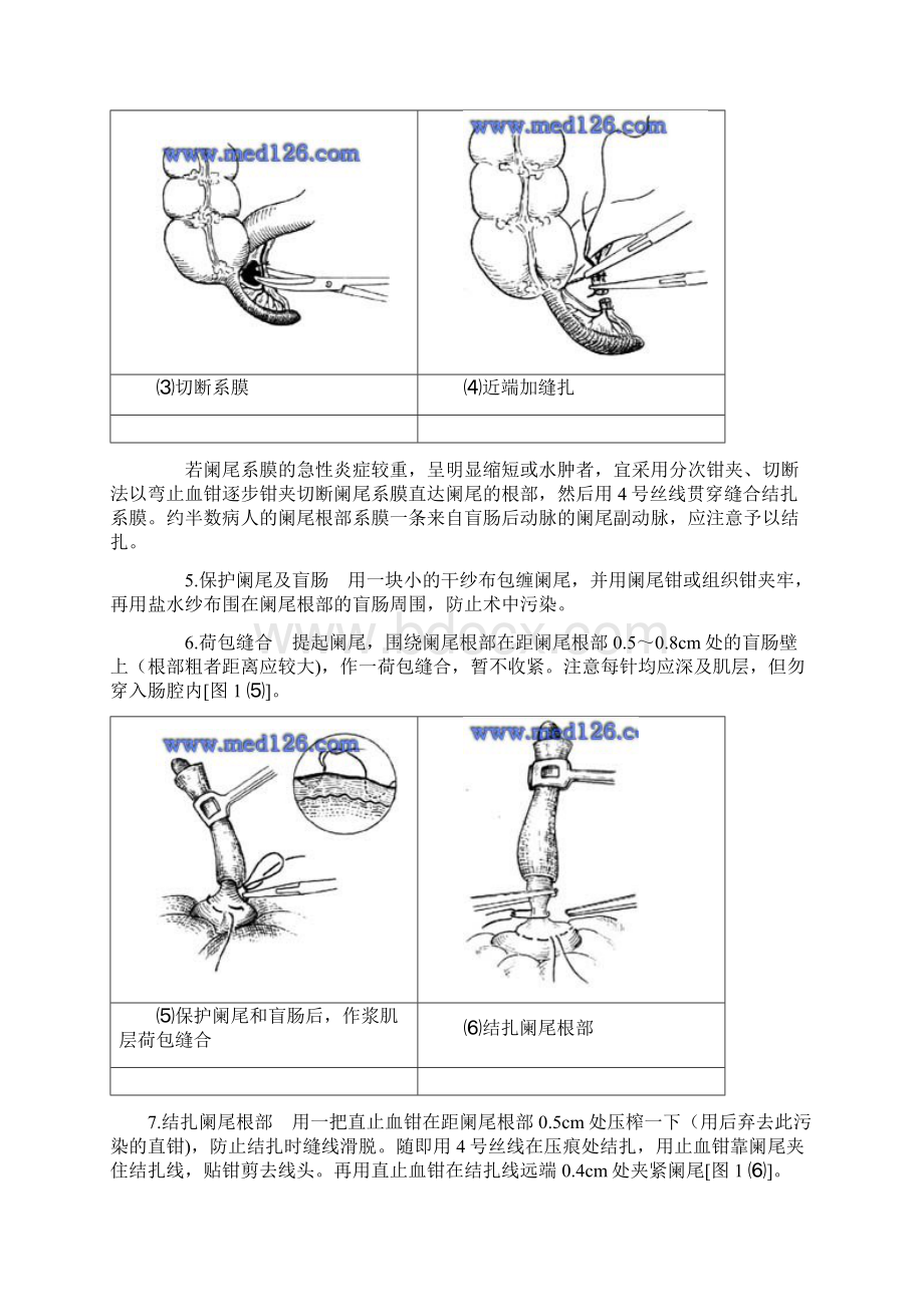 手术操作步骤流程示范急性阑尾炎手术的操作Word下载.docx_第3页