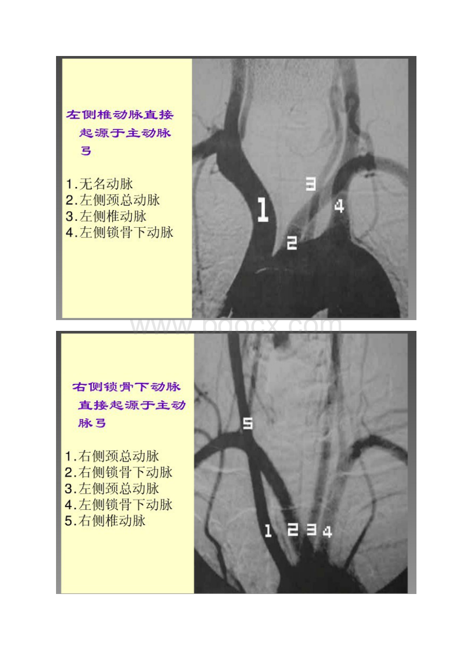 脑血管造影图片详解Word文件下载.docx_第3页