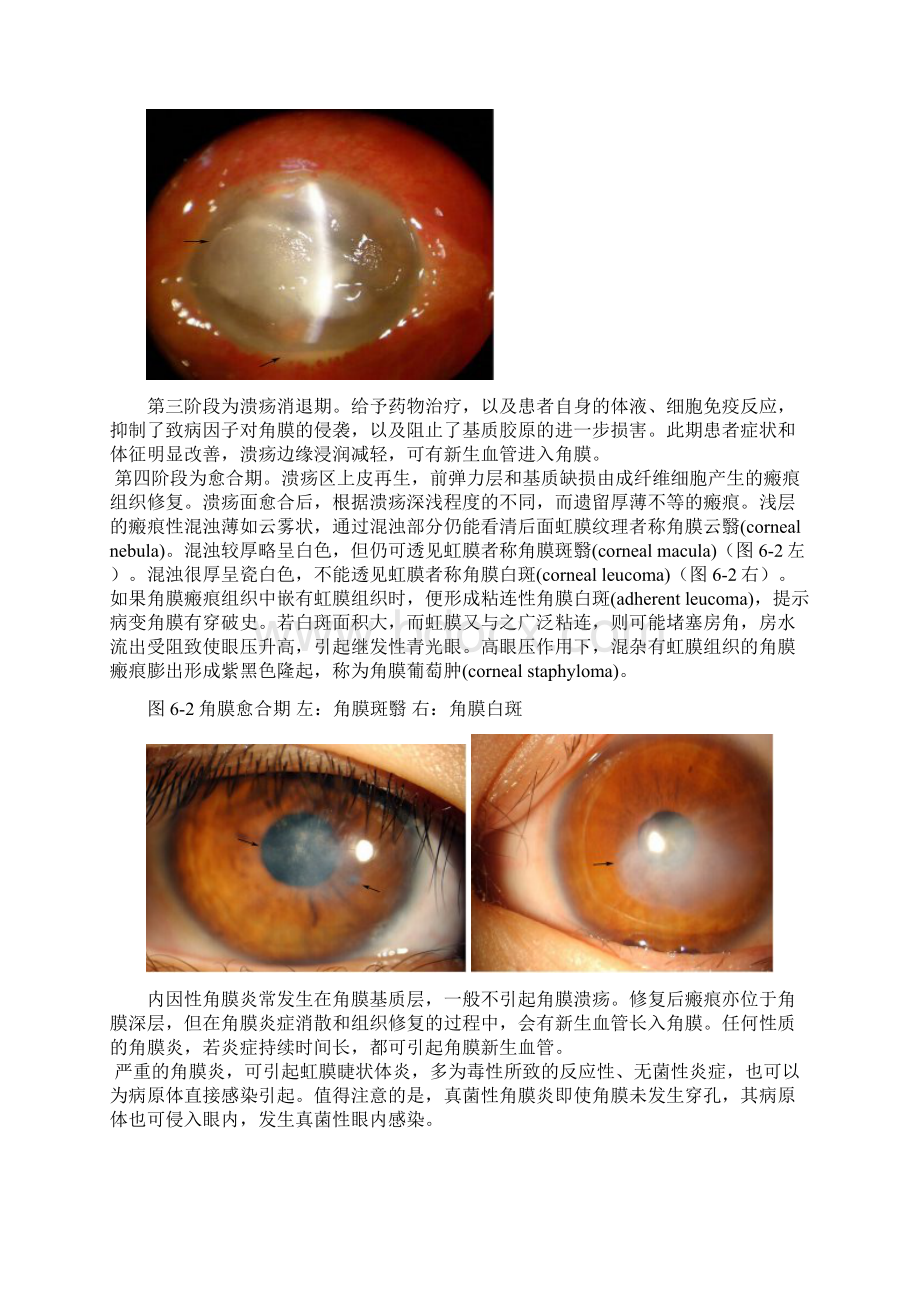 第六章角膜病Word格式文档下载.docx_第2页