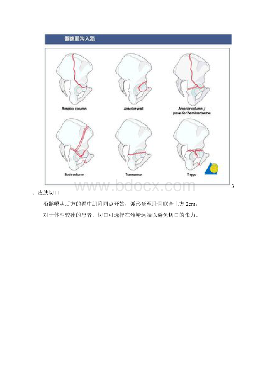 髂腹股沟入路解剖Word下载.docx_第2页